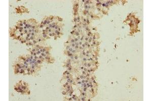Immunohistochemistry of paraffin-embedded human breast cancer using ABIN7174707 at dilution of 1:100