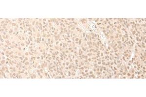 Immunohistochemistry of paraffin-embedded Human esophagus cancer tissue using CNOT10 Polyclonal Antibody at dilution of 1:50(x200) (CNOT10 抗体)