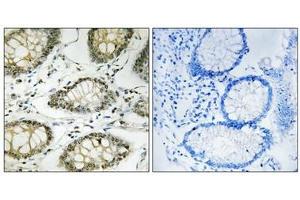 Immunohistochemistry analysis of paraffin-embedded human colon carcinoma tissue using ATR (Phospho-Ser428) antibody. (ATR 抗体  (pSer428))