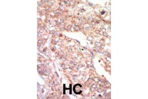 Formalin-fixed and paraffin-embedded human hepatocellular carcinoma tissue reacted with EPHA1 polyclonal antibody  , which was peroxidase-conjugated to the secondary antibody, followed by AEC staining. (EPHA1 抗体  (N-Term))