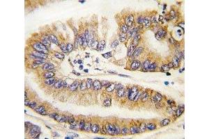 IHC analysis of FFPE human lung carcinoma tissue stained with PTEN antibody (PTEN 抗体  (AA 69-104))