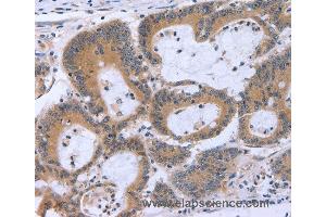 Immunohistochemistry of Human colon cancer using ECE1 Polyclonal Antibody at dilution of 1:30 (ECE1 抗体)
