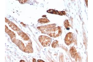 Formalin-fixed, paraffin-embedded human Breast Carcinoma stained with Flt3 / CD135 Mouse Monoclonal Antibody (FLT3/2458). (FLT3 抗体)