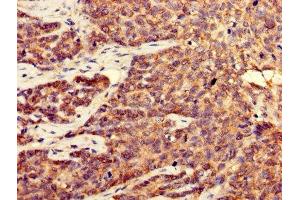 Immunohistochemistry of paraffin-embedded human ovarian cancer using ABIN7148931 at dilution of 1:100 (CDK5 抗体  (AA 1-292))