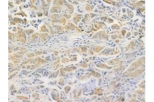 ABIN6260684 and ABIN6269374 at 1/100 staining human lung adenocarcinoma by IHC-P. (CDC37 抗体  (N-Term))