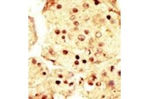 Formalin-fixed and paraffin-embedded human cancer tissue reacted with the primary antibody, which was peroxidase-conjugated to the secondary antibody, followed by AEC staining. (MAP3K9 抗体  (N-Term))