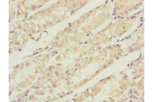Immunohistochemistry of paraffin-embedded human gastric cancer using ABIN7146746 at dilution of 1:100 (CBR4 抗体  (AA 1-237))