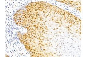 Formalin-fixed, paraffin-embedded human cervical cancer stained with p27 antibody (DCS-72. (P27 抗体)