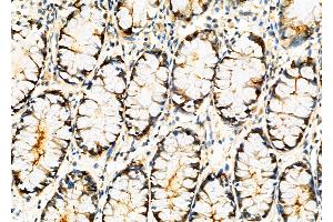 ABIN6261590 and ABIN6276833 at 1/100 staining Human colorectal cancer by IHC-P. (ERCC3 抗体  (N-Term))