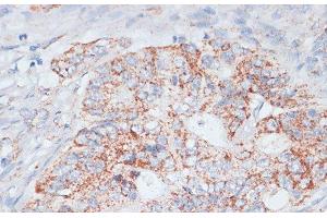 Immunohistochemistry of paraffin-embedded Human colon carcinoma using Desmoplakin Polyclonal Antibody at dilution of 1:100 (40x lens). (Desmoplakin 抗体)