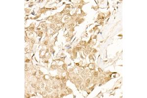 Immunohistochemistry of paraffin-embedded Human breast cancer using β-Catenin antibody (ABIN1684202, ABIN1512789, ABIN3020926 and ABIN3020928) at dilution of 25 (40x lens). (CTNNB1 抗体)