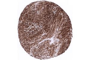 Gastrointestinal stromal tumor with strong CD34 expression