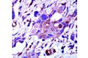 IHC analysis of FFPE human breast carcinoma tissue stained with the PLK1 antibody (PLK1 抗体  (AA 573-603))
