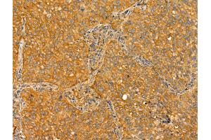 ABIN6265786 and ABIN6273022 at 1/100 staining Human lung cancer by IHC-P. (TTL 抗体)