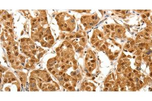 Immunohistochemistry of paraffin-embedded Human lung cancer tissue using TNN Polyclonal Antibody at dilution 1:40 (Tenascin N 抗体)