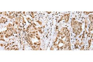 Immunohistochemistry of paraffin-embedded Human breast cancer tissue using ZNF486 Polyclonal Antibody at dilution of 1:50(x200) (ZNF486 抗体)