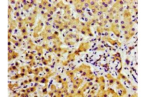 Immunohistochemistry of paraffin-embedded human liver cancer using ABIN7169191 at dilution of 1:100 (TAO Kinase 2 抗体  (AA 719-880))