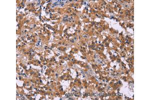 Immunohistochemistry of Human liver cancer using PIP5K1B Polyclonal Antibody at dilution of 1:30 (PIP5K1B 抗体)