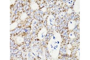 Immunohistochemistry of paraffin-embedded Human colon carcinoma using PDCD10 Polyclonal Antibody at dilution of 1:100 (40x lens). (PDCD10 抗体)