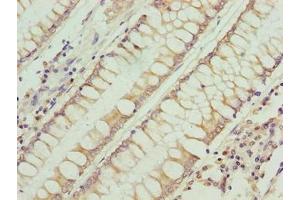 Immunohistochemistry of paraffin-embedded human colon cancer using ABIN7168228 at dilution of 1:100 (RFESD 抗体  (AA 1-157))