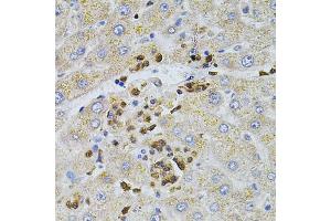 Immunohistochemistry of paraffin-embedded human liver injury using BEST1 antibody (ABIN4903043) at dilution of 1:100 (40x lens). (Bestrophin 1 抗体)