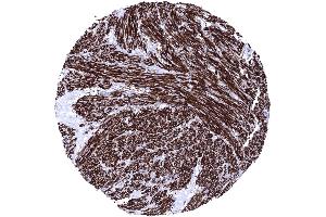 Uterus Leiomyosarcoma showing intense Caldesmon immunostaining of tumor cells Caldesmon immunohistochemistry (Recombinant Caldesmon 抗体)
