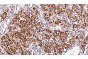 ABIN6278498 at 1/100 staining Human liver cancer tissue by IHC-P.