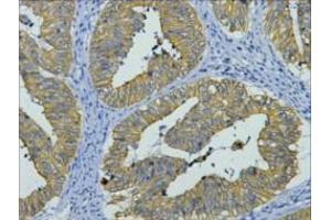 Immunohistochemistry (IHC) staining of Human Colon cancer tissue, diluted at 1:200.