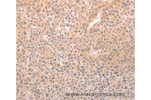 Immunohistochemistry of Human thyroid cancer using TRPC3 Polyclonal Antibody at dilution of 1:50 (TRPC3 抗体)