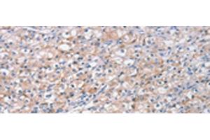 Immunohistochemistry of paraffin-embedded Human prost ate cancer tissue using STK16 Polyclonal Antibody at dilution of 1:30(x200) (STK16 抗体)
