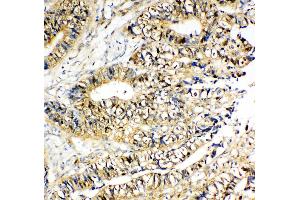 Anti-NME2 antibody, IHC(P) IHC(P): Human Intestinal Cancer Tissue (NME2 抗体  (C-Term))