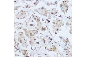 Immunohistochemistry of paraffin-embedded human breast cancer using GLI1 Rabbit pAb (ABIN7271533) at dilution of 1:150 (40x lens). (GLI1 抗体  (AA 200-300))