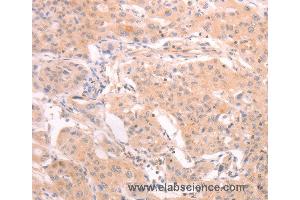 Immunohistochemistry of Human lung cancer using INA Polyclonal Antibody at dilution of 1:25 (INA 抗体)