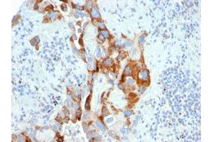 Formalin-fixed, paraffin-embedded human Colon Carcinoma stained with PMEPA1 Mouse Monoclonal Antibody (PMEPA1/2696). (PMEPA1 抗体)