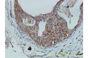 Immunoperoxidase of monoclonal antibody to F11R on formalin-fixed paraffin-embedded human breast cancer tissue. (F11R 抗体  (AA 1-299))