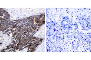 P-peptide - +Immunohistochemical analysis of paraffin-embedded human breast carcinoma tissue, using Connexin43 (Phospho-Ser367) antibody. (Connexin 43/GJA1 抗体  (pSer367))