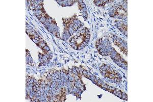 Immunohistochemistry of paraffin-embedded human colon carcinoma using Clusterin alpha chain Rabbit pAb (ABIN6133477, ABIN6138756, ABIN6138758 and ABIN6216721) at dilution of 1:100 (40x lens). (Clusterin 抗体  (AA 23-120))
