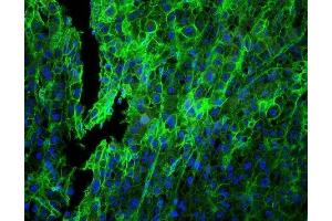 IF analysis of HLA-C using anti-HLA-C antibody (ABIN3043843) HLA-C was detected in paraffin-embedded section of human Lung cancer tissues.