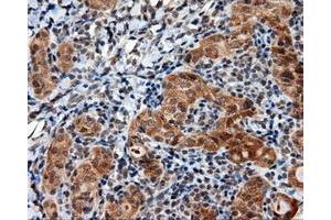 Immunohistochemical staining of paraffin-embedded Adenocarcinoma of ovary tissue using anti-LIPG mouse monoclonal antibody. (LIPG 抗体)