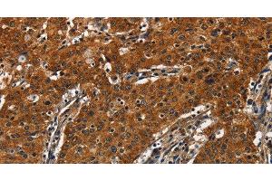 Immunohistochemistry of paraffin-embedded Human gastric cancer tissue using CATSPER4 Polyclonal Antibody at dilution 1:50 (CATSPER4 抗体)