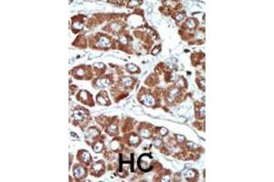 Formalin-fixed and paraffin-embedded human cancer tissue reacted with the primary antibody, which was peroxidase-conjugated to the secondary antibody, followed by DAB staining. (SIK1 抗体  (C-Term))