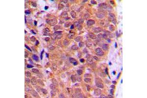Immunohistochemical analysis of FOXO1 (pS319) staining in human breast cancer formalin fixed paraffin embedded tissue section. (FOXO1 抗体  (pSer319))