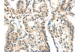 The image on the left is immunohistochemistry of paraffin-embedded Human thyroid cancer tissue using ABIN7192372(SIGLEC8 Antibody) at dilution 1/25, on the right is treated with synthetic peptide. (SIGLEC8 抗体)