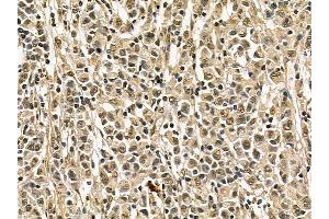 FER Mouse Monoclonal Antibody at 1/100 staining human gastric cancer by IHC-P. (FER 抗体)