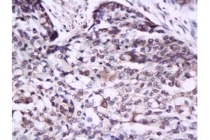 Formalin-fixed and paraffin embedded human esophagus carcinoma tissue labeled with Anti-IL-17/IL-17A Polyclonal Antibody, Unconjugated (ABIN738891) at 1:300 followed by conjugation to the secondary antibody and DAB staining (IL-17 抗体  (AA 85-150))