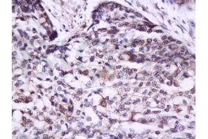 Formalin-fixed and paraffin embedded human esophagus carcinoma tissue labeled with Anti-IL-17/IL-17A Polyclonal Antibody, Unconjugated (ABIN738891) at 1:300 followed by conjugation to the secondary antibody and DAB staining