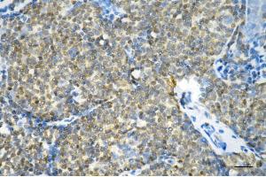 Immunohistochemistry was performed on paraffin-embedded human breast carcinoma using glutathione-disulfide reductase antibody (ABIN7798754), 1:200). (Recombinant Glutathione Reductase 抗体)