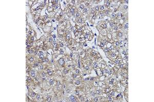 Immunohistochemistry of paraffin-embedded human liver cancer using ZNF259 Rabbit mAb (ABIN1512700, ABIN7101439, ABIN7101440 and ABIN7101441) at dilution of 1:100 (40x lens). (ZNF259 抗体)