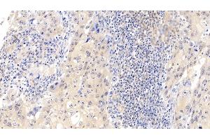 Detection of CDK4 in Human Lymphoma Tissue using Polyclonal Antibody to Cyclin Dependent Kinase 4 (CDK4) (CDK4 抗体  (AA 6-295))