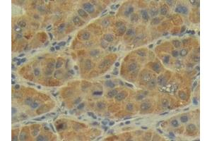 Detection of P-cadherin in Human Liver cancer Tissue using Polyclonal Antibody to Placental Cadherin (P-cadherin) (P-Cadherin 抗体  (AA 371-660))